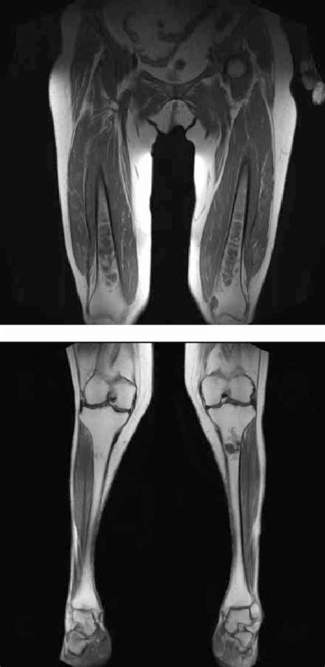 Magnetic Resonance Imaging (MRI) of the Bones, 